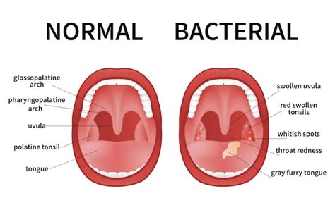 Viral Inflamed Tonsils 11396 The Best Porn Website