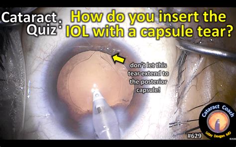 Cataract Quiz: IOL with capsule tear – Cataract Coach