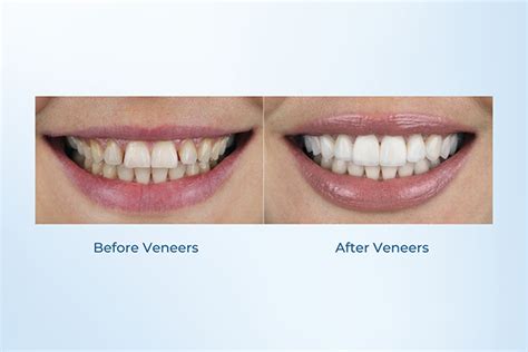 Composite Veneers Pros And Cons