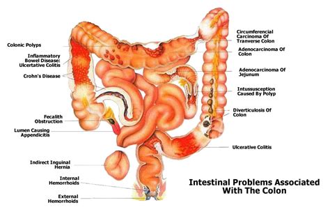 About The Colon - Colon Health - Symptoms Of Colon Cancer