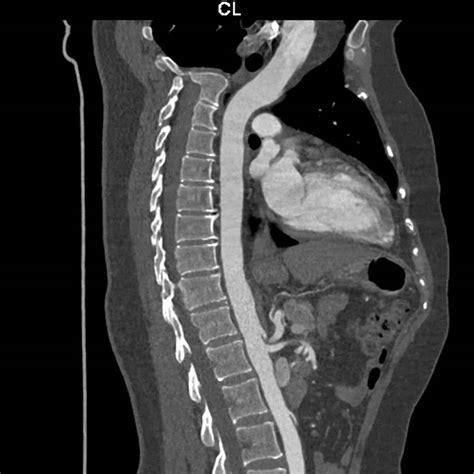 How Effective Is A Low Dose Ct Scan Melbourne Radiology