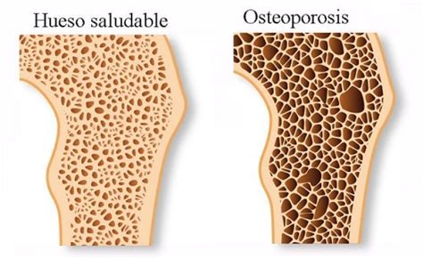 ¿qué Es La Osteoporosis Mov Rehabilitación