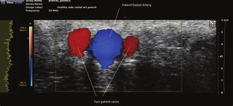 Example Of High Resolution Ultrasound Assessment Of Vessel Patency Download Scientific Diagram