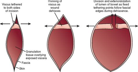 General Laparotomy | Basicmedical Key