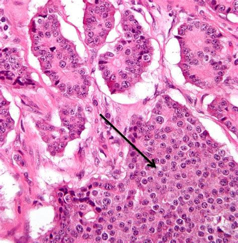 Carcinoid Syndrome Usmle Strike