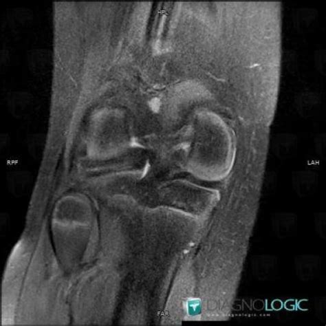 Radiology case : Discoid meniscus (MRI) - Diagnologic