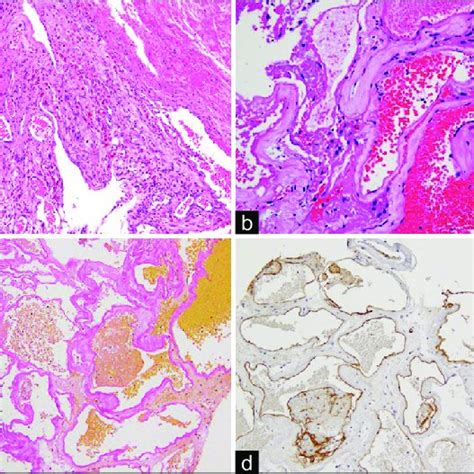 Photomicrograph Of The Surgical Specimen Stained With Hematoxylin And