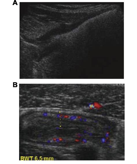 (A) Longitudinal segment of the colon showing loss of haustra. (B ...