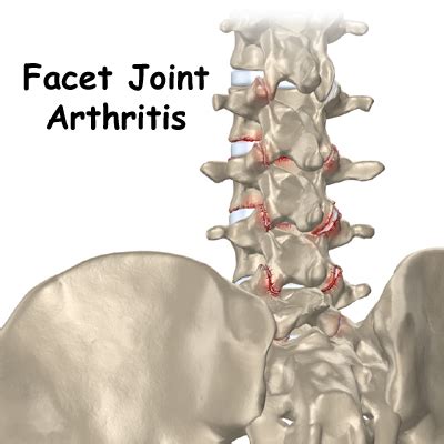 Facet Joint Arthritis (Spondylarthritis) Treatment in Singapore ...