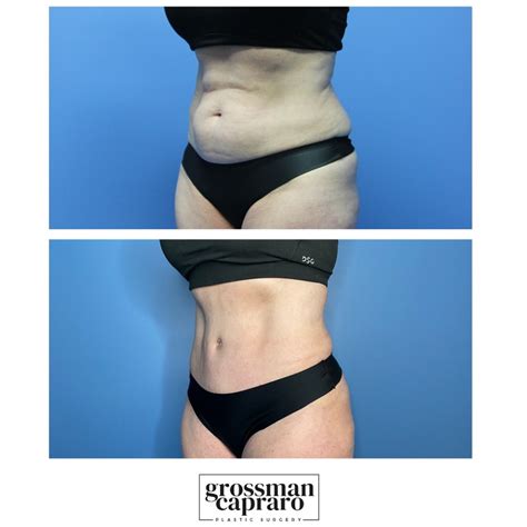 Tummy Tuck 101 A Comprehensive Guide To The Procedure