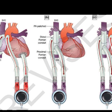 Configurations Of Continuous Flow Vad In The Fontan Circulation A