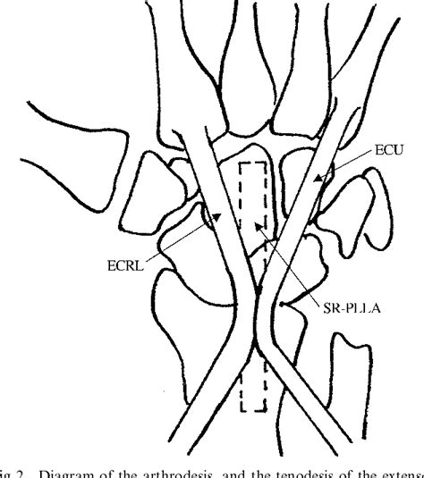 Table From Arthrodesis Of The Wrist With Bioabsorbable Fixation In