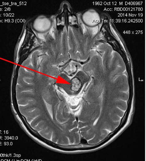 Cavernoma definition: What is a cavernoma, what is treatment and ...