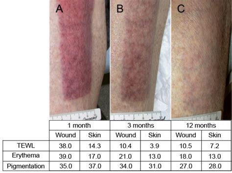 Skin Graft Color Healing