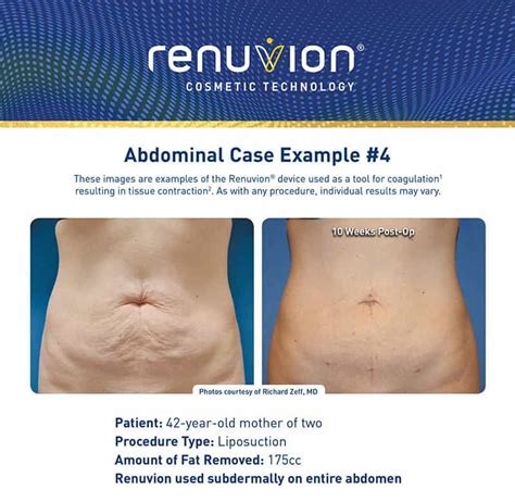 Renuvion Skin Tightening Pasadena Ca Dr Nima Plastic Surgery