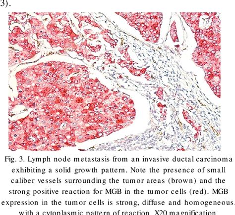 Figure 3 From Microvessel Density And Mammaglobin A Expression As