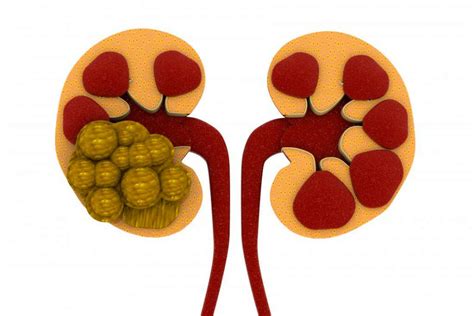 Kidney Pain: 10 Causes of Kidney Pain