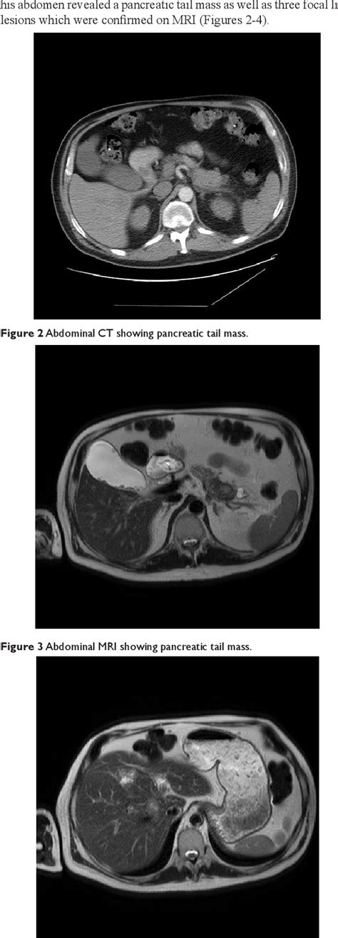 Figure 1 From Identifying Necrolytic Migratory Erythema In Glucagonoma