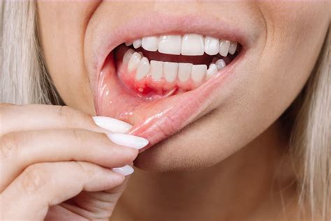 All About Periodontitis Causes Symptoms And Treatment Options