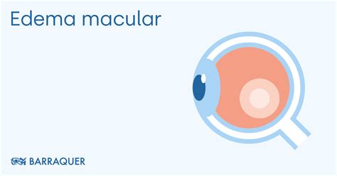 Edema Macular Causas S Ntomas Y Tratamientos