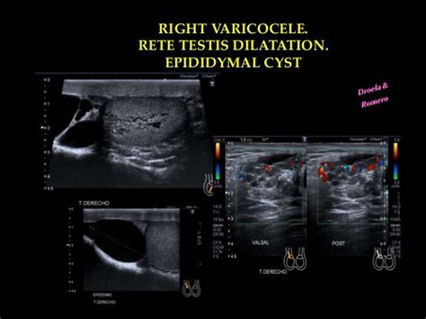 Right varicocele. Ultrasound.