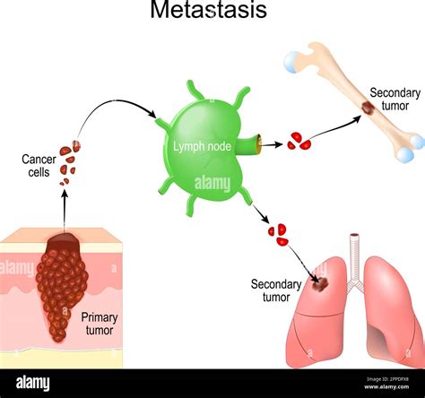 Metastasis Cancer Cells From Primary Tumor Survive In Lymph Node And