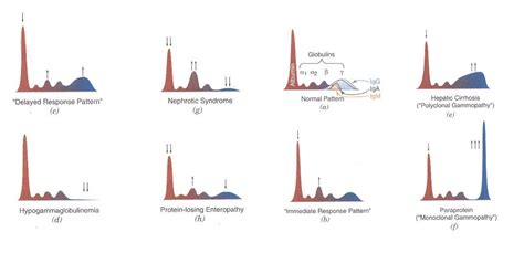 Medical Laboratory And Biomedical Science Serum Protein Electrophoresis