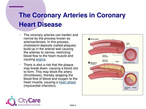 Ppt Stable Angina M Anagement According To Nice Guidelines