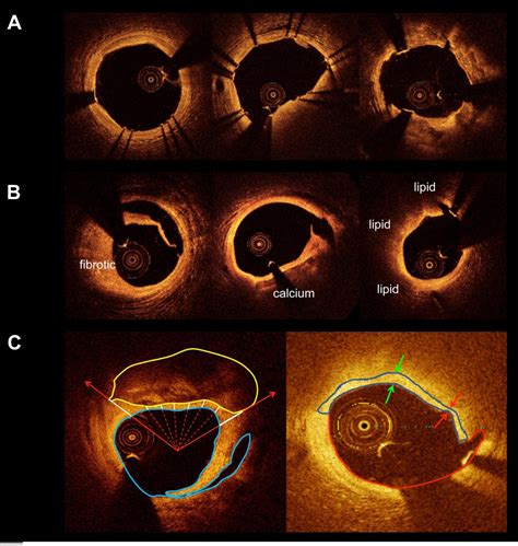 Incidence Predictors Morphological Characteristics And Clinical