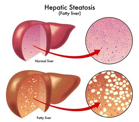 Prognosis Non-alcoholic Fatty Liver - Alomedika