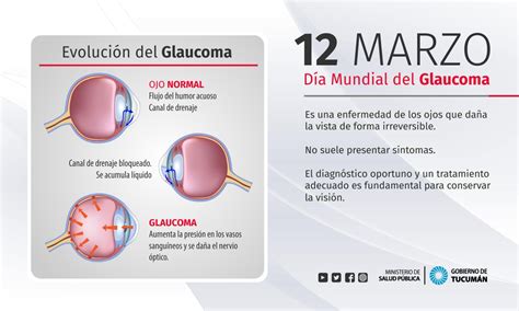 Se Conmemora El Día Mundial Del Glaucoma La Segunda Causa De Ceguera