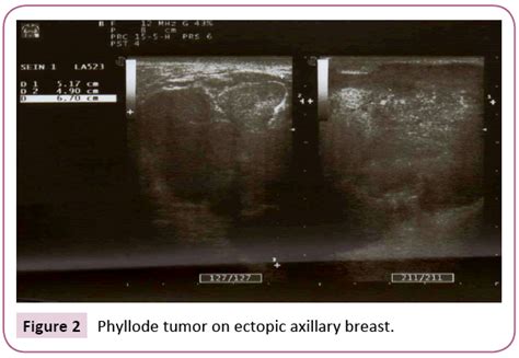 Malignant Phyllodes Tumor In Ectopic Breast Tissue A Case Report