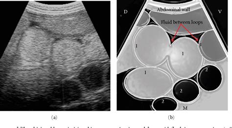 Table 2 From Usefulness And Limitation Of Ultrasonography In The