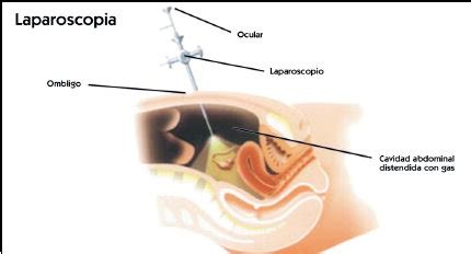 Ligadura De Trompas Una Decisi N Dif Cilmente Reversible El M Dico