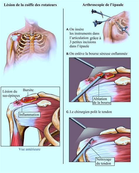 Bursite L Sion Coiffe Bursectomie Nettoyage Douleur Epaule Bursite