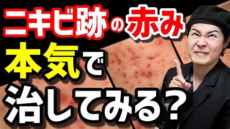 【ニキビ跡をケアする方法】消えない赤みを薄くするには？ Youtube