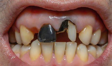 What Are The Causes Of Black Teeth In Adults