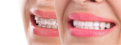 What Is The Difference Between At Home Clear Aligners And Regular Braces