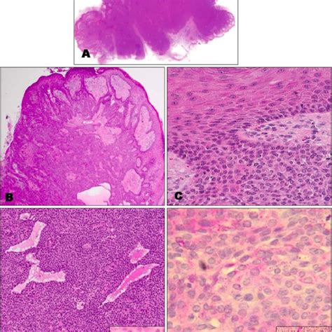 A A Single Pedunculated Large Tumor Mass And Well Circumscribed Tumor