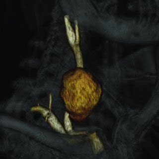 Three Dimensional Reconstruction Of Computed Tomography Ct Angiogram