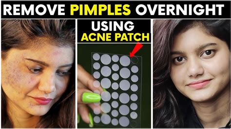 Remove Pimples Acne Overnight By Acne Patch Technique Working