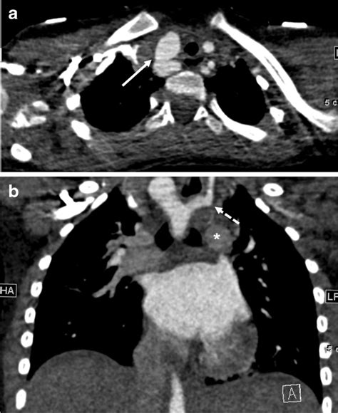 Right Aortic Arch And Aberrant Left Subclavian Artery In A 5 Year Old