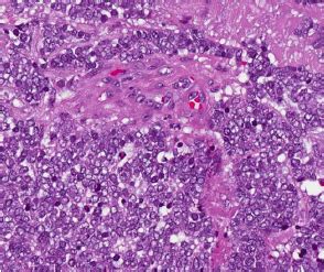 b. Histology of Merkel cell carcinoma | Download Scientific Diagram