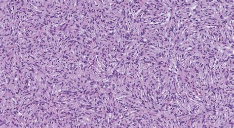 Dermatofibrosarcoma protuberans | Ottawa Atlas of Pathology