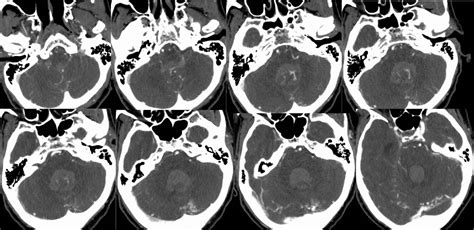 Avm With Pica Aneurysm