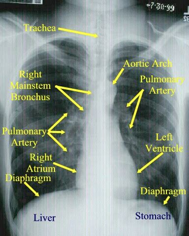 Chest Radiographs Flashcards Quizlet