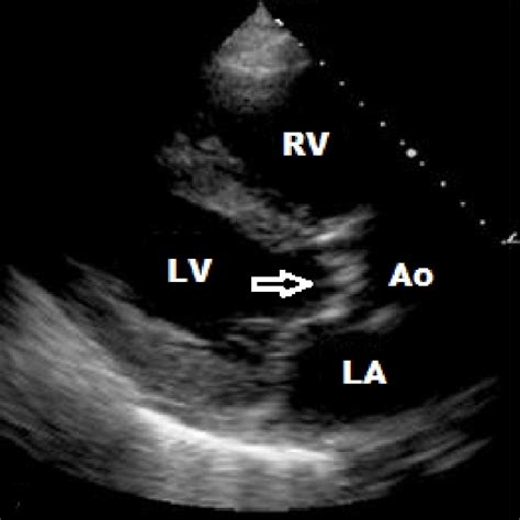 Transthoracic Echocardiogram Parasternal Long Axis View Showing