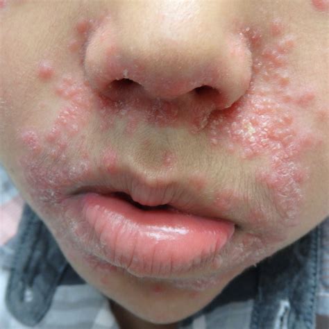 Periorificial Dermatitis Pediatric Dermatology