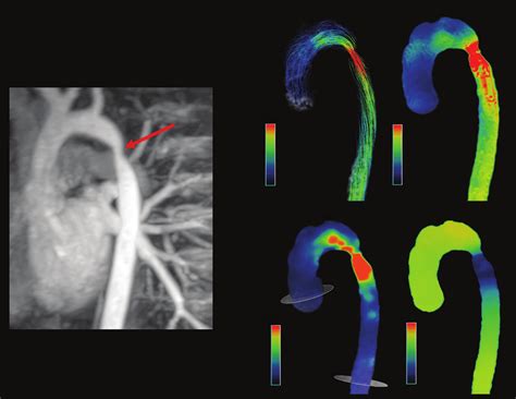 Coarctation Maximum Intensity Projection Reconstruction Of Mr Download Scientific Diagram