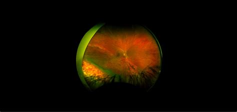 Scleral Buckle - Case Study